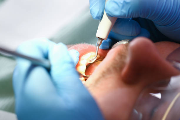 Best Emergency Wisdom Teeth Removal in Mcadenville, NC