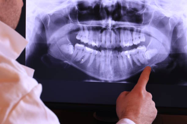 Best Emergency Root Canal Treatment in Mcadenville, NC